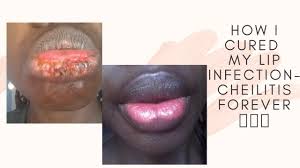 how i cured lip infection cheilitis