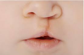 cleft rhinoplasty correction of nasal