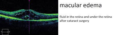 causes and treatment of macular edema