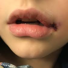 before after lip laceration photos