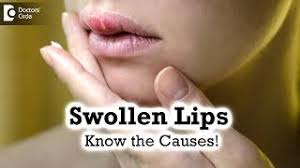 swollen lips causes home remes