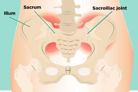 The muscular tissues and also ligaments in the back can stretch or tear because of excess activity. Sacroiliac Si Joint Pain Understanding Causes Symptoms Treatment