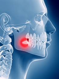 impacted teeth how can you deal with them