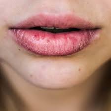 dry lips causes and hydrating lip care