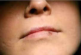 discoloration of the lower lip