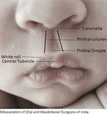 cleft lip springerlink