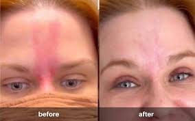 rosacea treat burning irritation