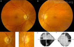 While often idiopathic, anterior ischemic optic neuropathy occasionally may occur fro. Successive Presentation Of Arteritic And Non Arteritic Anterior Ischemic Optic Neuropathy
