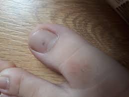 spot on my toe nail i kinda pressed