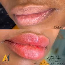 best permanent lip contour treatment