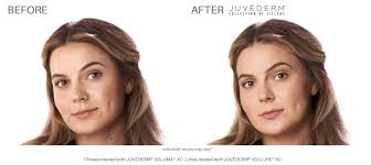 juvéderm before and after real