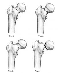 fem neck hip fracture physiopedia
