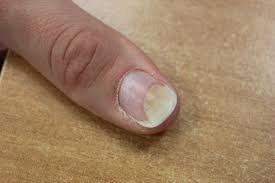 causing fingernail onychomycosis