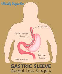 gastric sleeve surgery comprehensive