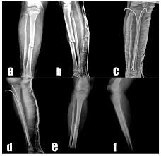 pediatric tibial shaft fractures