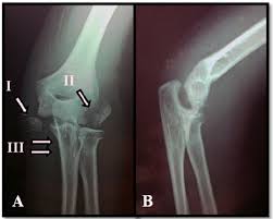 Specifically in passive flexion of the elbow, it is subcutaneous and generally noticeable. X Ray Views Of The Left Elbow A Anteroposterior X Ray View Of The Download Scientific Diagram