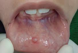 mucocele in the lower lip