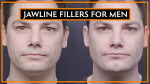 Injecting hyaluronic acid dermal fillers into the jawline can give men who feel. How Dermal Fillers Can Change Your Jawline Youtube