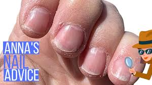 can you rebuild damaged nails anna s
