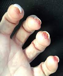 acute nail changes after manicure with