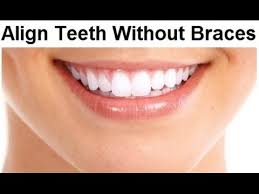 Depending on your specific condition, there are other options besides braces to consider. Can I Get Straight Teeth Without Braces By Prof John Mew Youtube