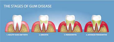 If periodontal disease is detected and treated in its early stages, this disease can be reversed. Can Bone Loss In Teeth Through Gum Disease Be Reversed