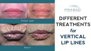 how vertical lip lines lip wrinkles