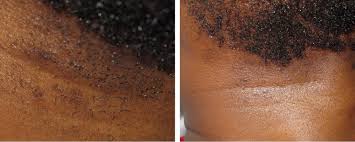 Thinking about home laser hair removal. Laser Hair Removal For Dark Skin London Premier Laser Clinic