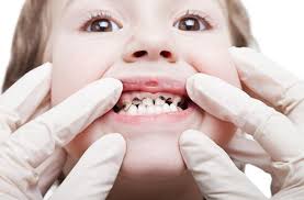 استخدم الطب البديل لعلاج تسوس الاسنان بالقرنفل والثوم - اليوم السابع