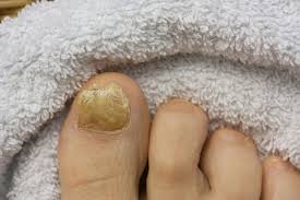 unsightly toenails and fungal infection