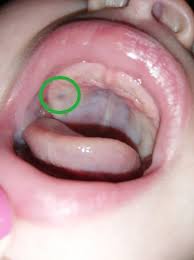 black spot on baby s gum roof of mouth
