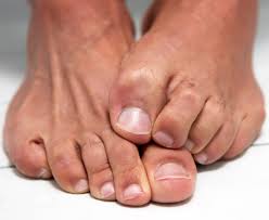 how to get rid of foot fungus for good
