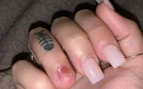acrylic nail ripped off real nail