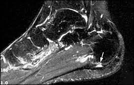 Mri patterns of neuromuscular disease involvement thigh & other muscles 2. Radiologic Evaluation Of Chronic Foot Pain American Family Physician