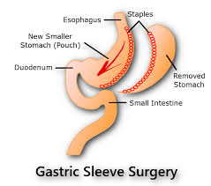 gastric sleeve expected weight loss