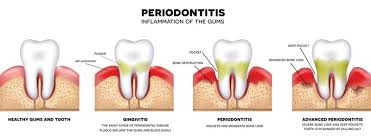 Untreated periodontal disease can lead to bone loss in the supporting jawbone. Gum Disease Therapy Julie Stante Dds