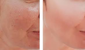 costs of laser skin resurfacing a