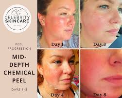 chemical ls aging acne wrinkles