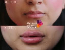 what are the best practices for lip