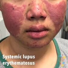 lupus skin deep