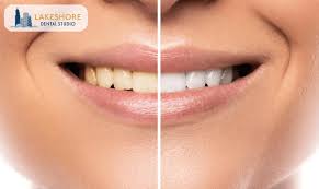 home teeth whitening kits