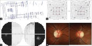 Management Of Diplopia With Visual Field Defects Kao Ly Liu
