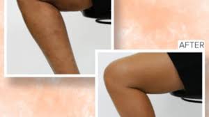 how to cover up leg veins scars and