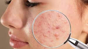 lifestyle habits and acne scarring