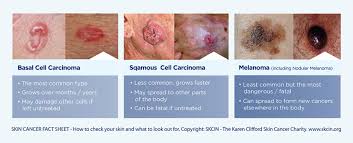 skin cancer how to check your skin and
