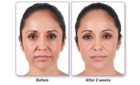 dermal fillers injections