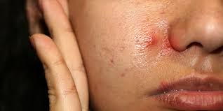 hard pimples meaning causes