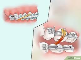 Understanding how to put on these rubber bands is important to wearing braces, as well as helping preserve the hardware of the braces. How To Connect A Rubber Band To Your Braces 12 Steps