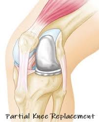 partial knee replacements faq knee