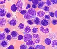 pathology outlines megaloblastic anemia